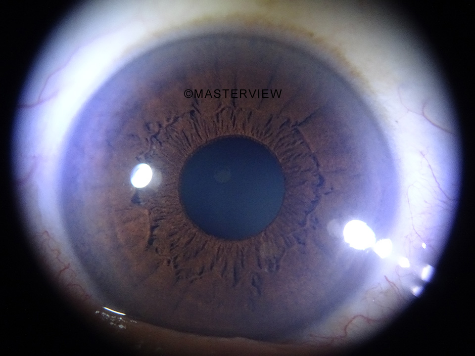 Iridologia - Foto de íris obtida com o Iridophoto HX
