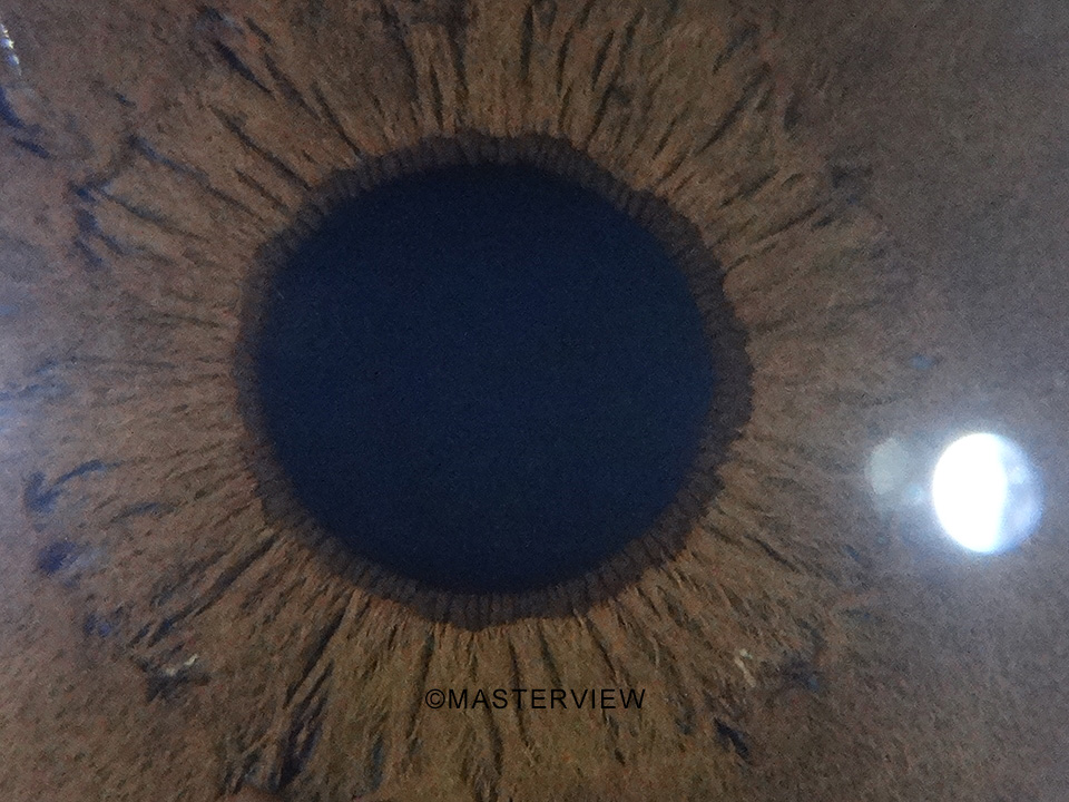Iridologia - Foto de íris obtida com o Iridophoto HX